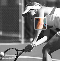 Τennis elbow_Φυσικοθεραπεία