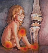 Childhood arthritis.