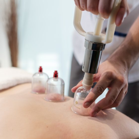 cupping therapy_Physiopolis